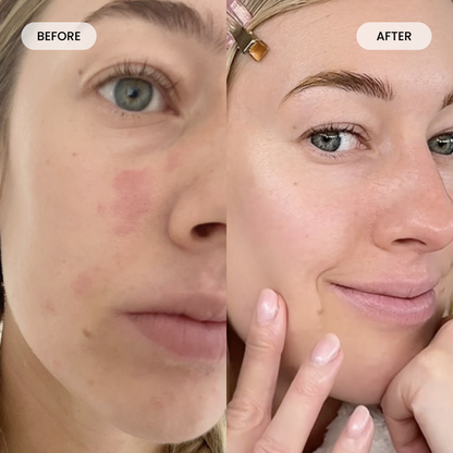 Fybelle LED Face Mask Calms Redness