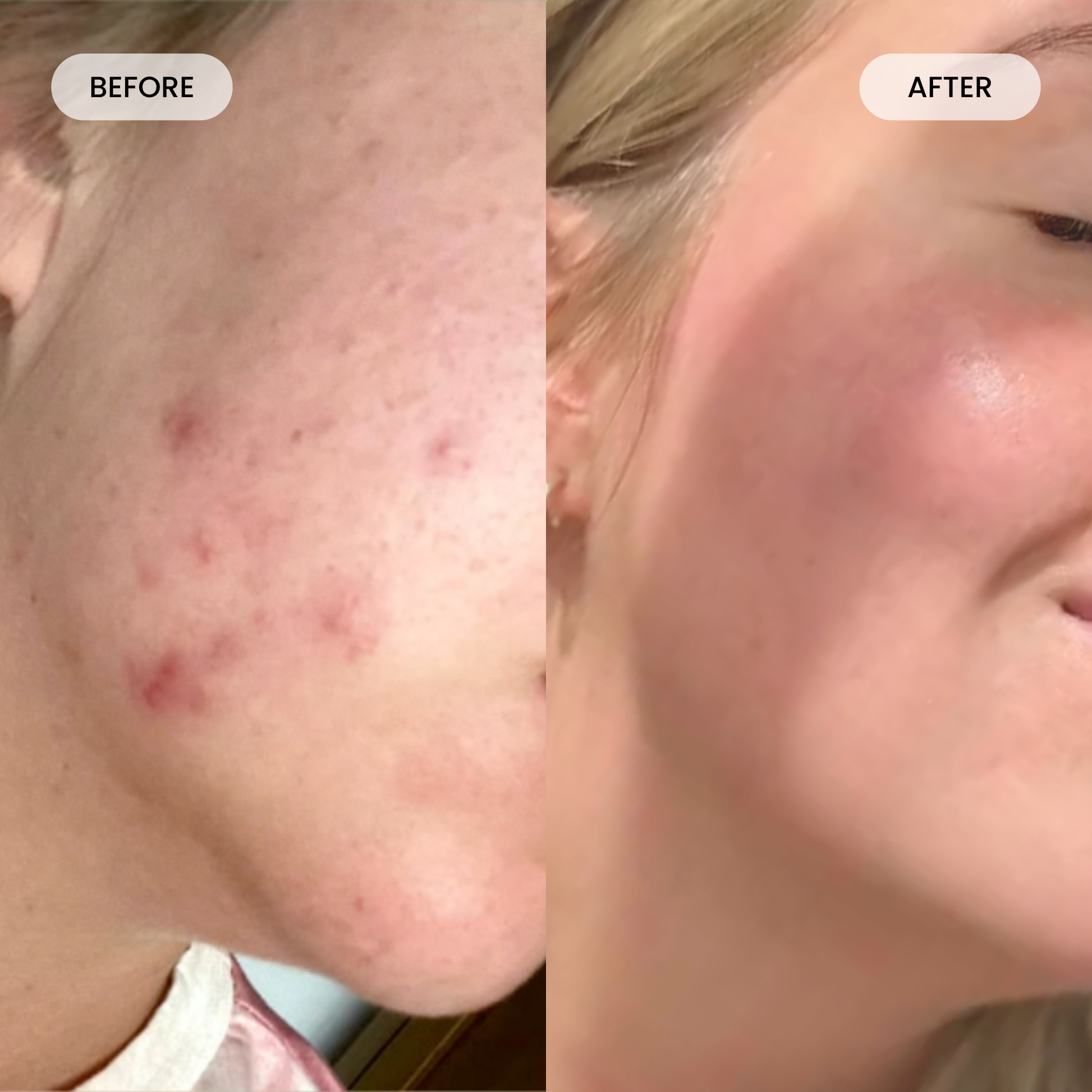 Fybelle LED Face Mask Targets Acne & Prevents Breakouts