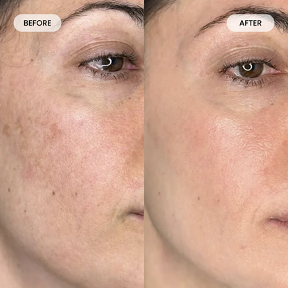 Fybelle LED Face Mask evens skin tone